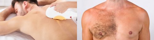 Epilation-definitive-homme-Lyon