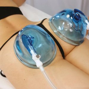 rehaussement-fessier body-lift-lyon